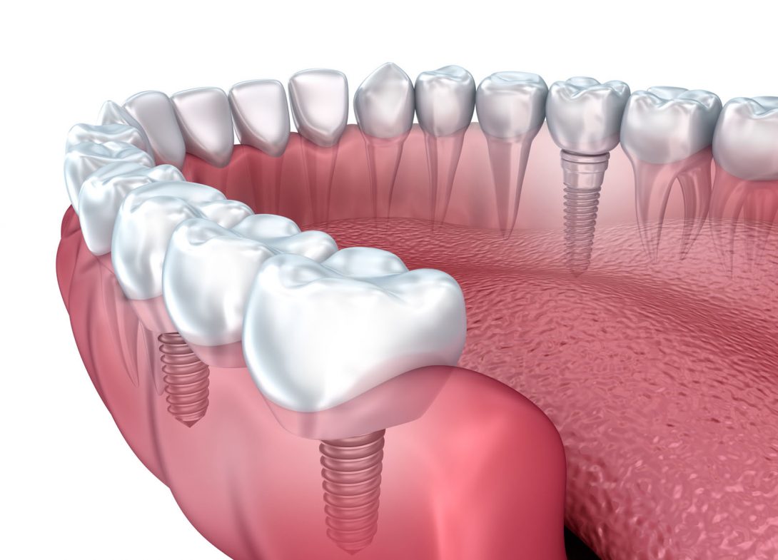 Ultimate Dental Implants Guide: Tips For Successful Treatment
